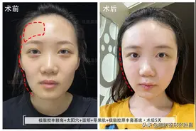 28岁江苏美女，牙齿矫正后却意外脸型变丑，凹陷脸如何能再变美？图片