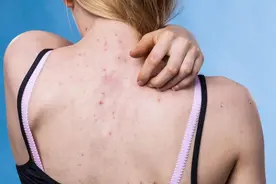 背上长痘难解决？4招教你解决后背的痘痘，让你拥有迷人美背图片