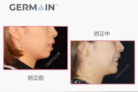 郑州隐适美：让圆钝的下颌线条更立体图片