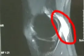 腿弯处鼓起一个肿块，涨涨的，是肿瘤吗？图片
