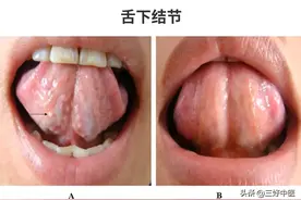中医望诊窍门（三）：看看舌底就可判断尿酸是否偏高图片