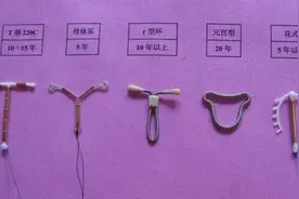 避孕环、节育环、宫内节育器，到底是个啥？图片