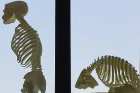 奇迹！“折叠人”复原了 依托市一院3D打印技术，身高0.9米的她恢复到1.5米图片