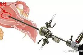 【献礼母亲节】母亲节，别忘了孕育宝宝的宫殿——聊聊宫腔镜的应用图片