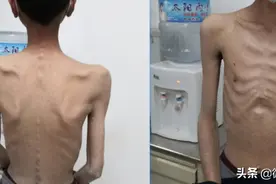患者皮包骨入院，要求打营养针，被医生无情拒绝图片