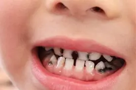 3岁宝宝从不吃糖，却还是满口蛀牙，牙医指出的问题值得重视图片