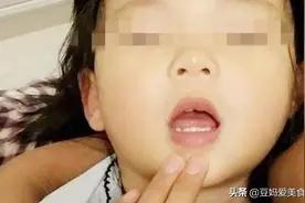 3岁女儿鱼刺卡住喉咙，妈妈第一时间这样处理，医生赞不绝口图片