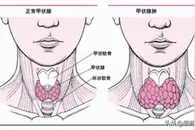甲状腺全切后，身体会发生怎样的变化？哪些情况需要切除甲状腺？图片
