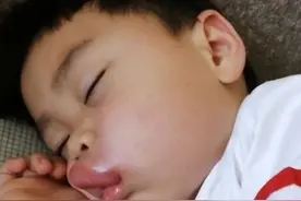 5岁男孩嘴巴肿得像“香肠”，宝妈觉得可爱，邻居：快送医院图片