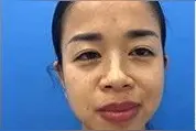 你是否也为鼻子过大烦恼，来看看这个大鼻子女孩的蜕变图片