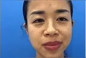 你是否也为鼻子过大烦恼，来看看这个大鼻子女孩的蜕变图片
