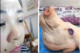 整形医生不爱做双眼皮手术的原因？答案：收费低、要求高、纠纷多图片