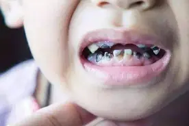 6岁孩子天天都刷牙却需要换假牙，是医生乱诊断还是父母太大意？图片