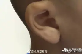 “掏耳屎”时乱动，四岁娃鼓膜穿孔流脓...图片