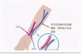 人工血管内瘘：连接的不仅是血管，更是希望图片