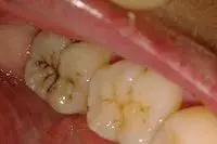 一次补牙，竟可省几百元，看后涨认知了图片