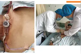 西青医院耳鼻喉科成功完成首例高难喉癌切除手术创新高图片
