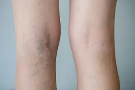 血栓到来时，腿部会有多种异常的表现，要重视起来，避免堵塞血管图片