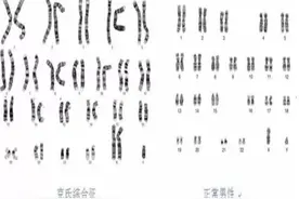 青春期男孩阴茎小咋办？哈医大一院儿科专家提示性发育延迟要早发现早治疗图片