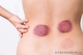 夏天拔罐后颜色越深说明湿气越重？关于拔罐你一定要知道的知识图片