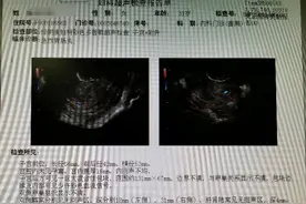 【你真的了解宫外孕吗?---一例输卵管间质部女妊娠破裂分享】图片