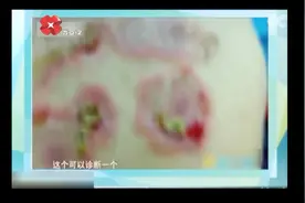 暖宝宝贴身上睡觉，致使孩子烧伤，医生：浅二度烫伤！视频封面
