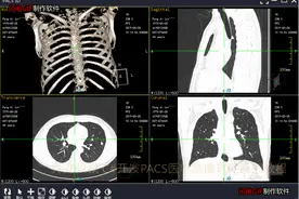 C#开发PACS医学影像三维重建(一)使用VTK重建3D影像图片
