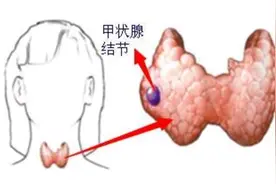 再一次提醒：要想甲状腺结节尽快好转，3种“水果”尽量不要吃图片