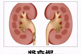 疾病专题 | 直播肾小球疾病的概述图片