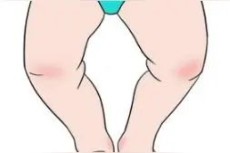 孩子出现“O型腿”是遗传的吗？儿科医生：可从这些方面改善图片