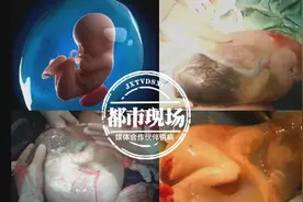 神奇！女婴出生如透明巨蛋，医生这样解释图片