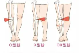 腿型矫正系列——每天10分钟，这个动作可以帮你轻松矫正XO型腿图片