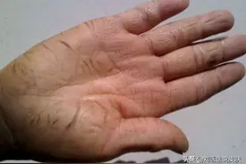 手脚皲裂有救了！教你「白+黑」护理方法，重现柔嫩肌肤图片