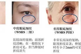 眼周细纹暴露年龄，你还不重视吗？图片