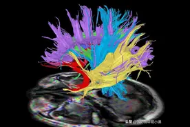神经磁共振（MRI）系列之脑灰质病变-精品图集图片