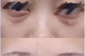 50岁皮肤还能拯救吗？黑眼圈眼袋、皮肤下垂、老化、皱纹怎么办图片