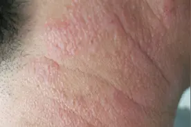 痒痒痒，痒了抓，抓了还痒，多是神经性皮炎在作祟图片