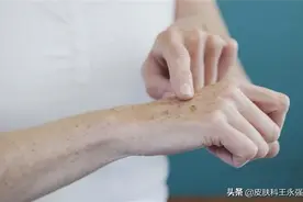 长了老年斑，有办法淡化吗？是否能彻底去除，皮肤科医生给你答案图片