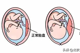 胎盘增厚，是代表着胎盘早剥了吗？图片