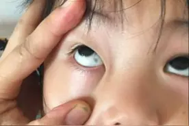 孩子的眼白有“黑点”？多半是这3个原因引起，父母不必太慌张图片