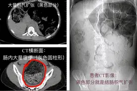 女高中生长期便秘，一查子宫都被挤偏！治疗后一夜“轻”了8斤图片