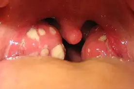 用劲一咳，咳出了白色颗粒？警惕这个病图片