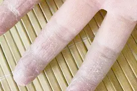 出现手指或脚掌脱皮时我们应该怎么办呢？教你一个小妙招！视频封面
