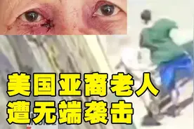 美国七旬亚裔老人当街遭人袭击 鼻子和右眼眶骨折图片