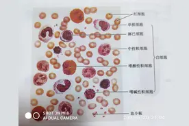 皮下有出血，原来是——血小板图片