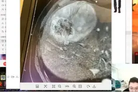 PDD:我的肿瘤手术难度排医院年度前十,成功后可以发学术论文了!图片