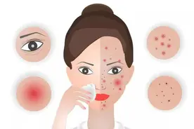 脸起皮干燥紧绷刺痛发红？摆脱敏感肌苦恼看这里图片