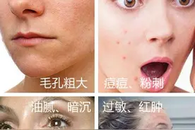 国产黑头收割机，全网销售超400万，5分钟黑头自动“浮”上来图片