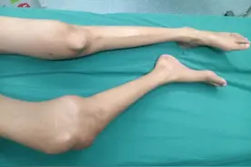 发现骨肉瘤，两成患者已有肺转移，提醒：5处关节疼痛别大意图片