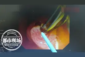 男子体内出现大量活肝吸虫，医生：和饮食习惯有关图片